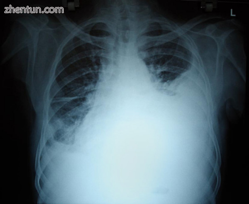 Massive pleural effusion, later proven to be hemothorax in a South Indian male..png