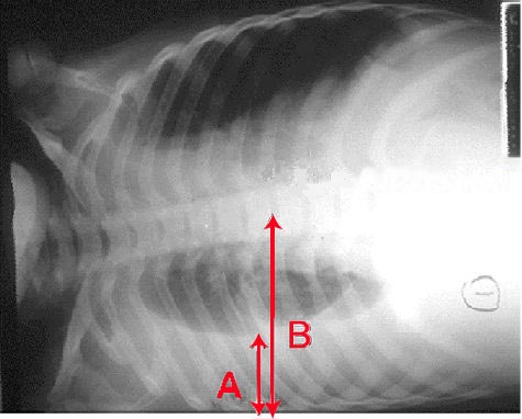 Pleural effusion Chest X-ray of a pleural effusion. The arrow A shows fluid laye.jpg