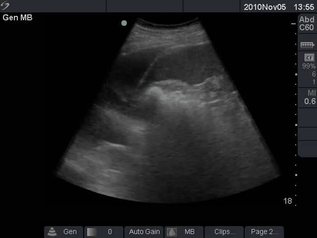 The lung expanding within an area of pleural effusion as seen by ultrasound.gif