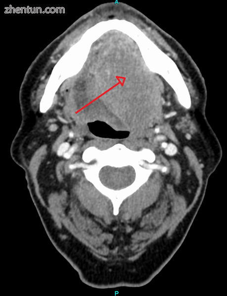 A large head and neck squamous cell carcinoma of the tongue as seen on CT imaging.png