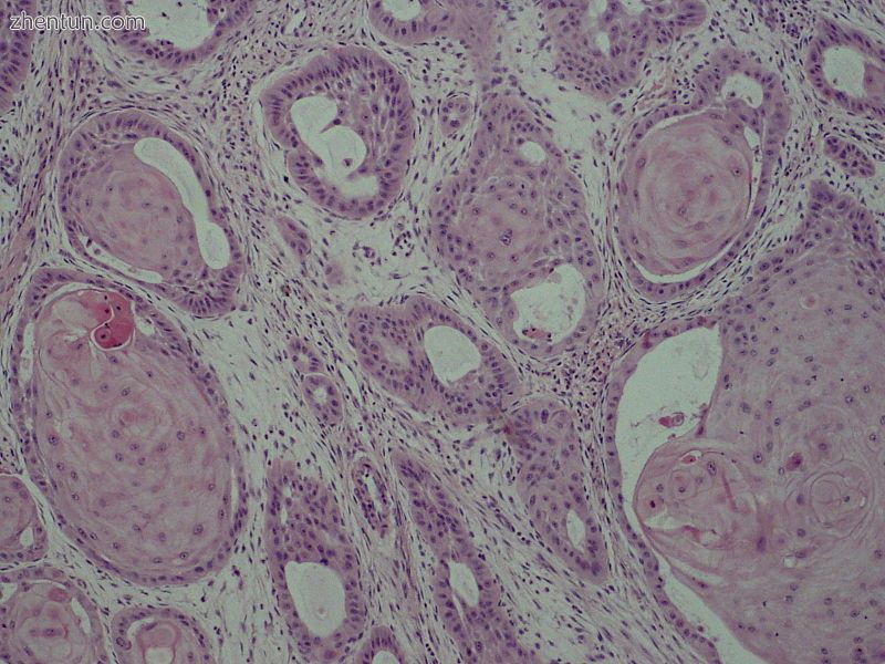 Adenoid squamous cell carcinoma.JPG