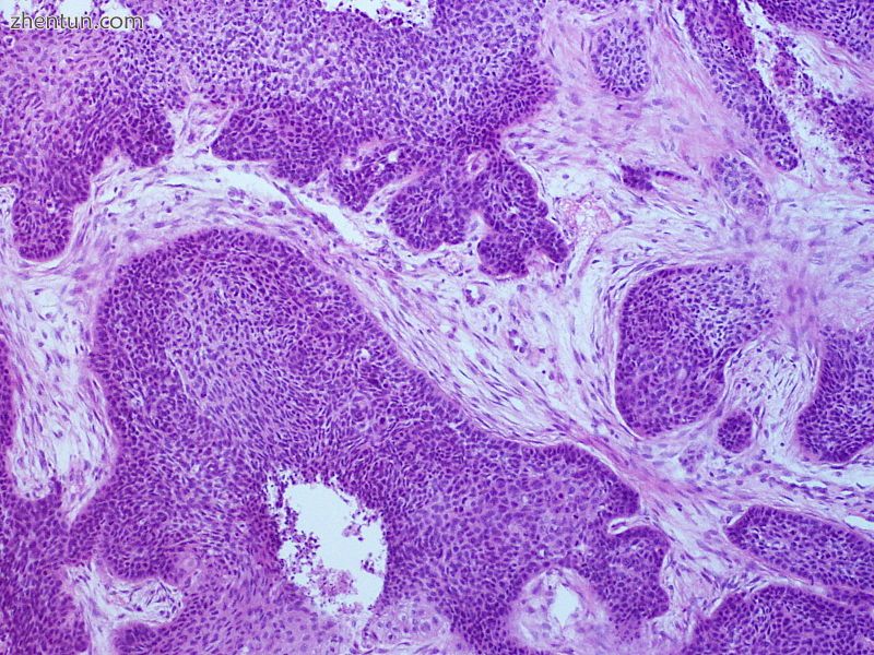 Basaloid squamous cell carcinoma.JPG