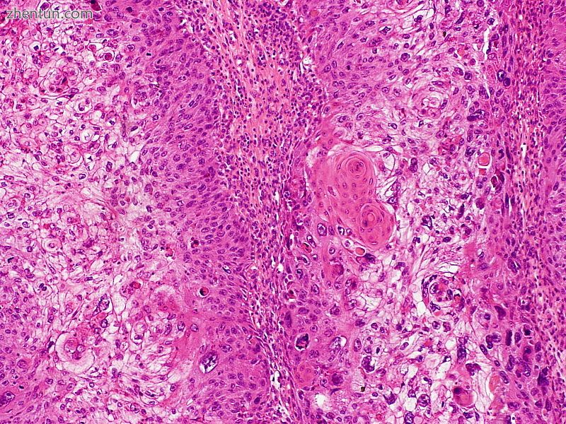 Clear-cell squamous cell carcinoma.JPG