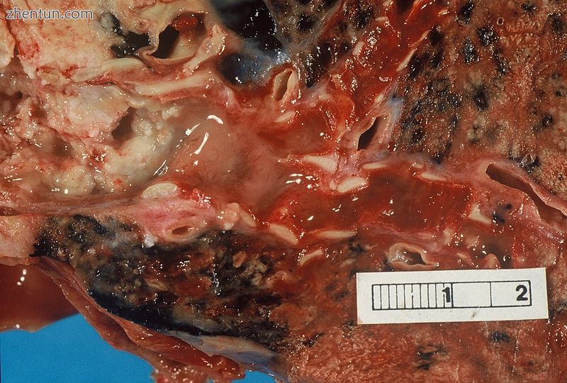 Photograph of a squamous cell carcinoma Tumour is on the left, obstructing the b.jpg