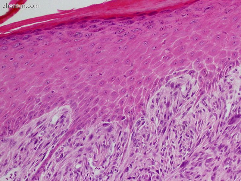 Spindle-cell squamous cell carcinoma.JPG