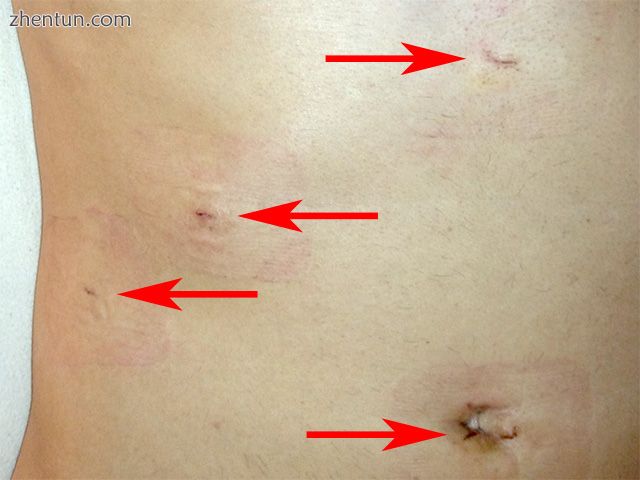 The 1-week-old incisions of a post-operative laparoscopic cholecystectomy as ind.jpg