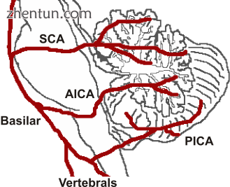 Locked-in syndrome can be caused by stroke at the level of the basilar artery de.png