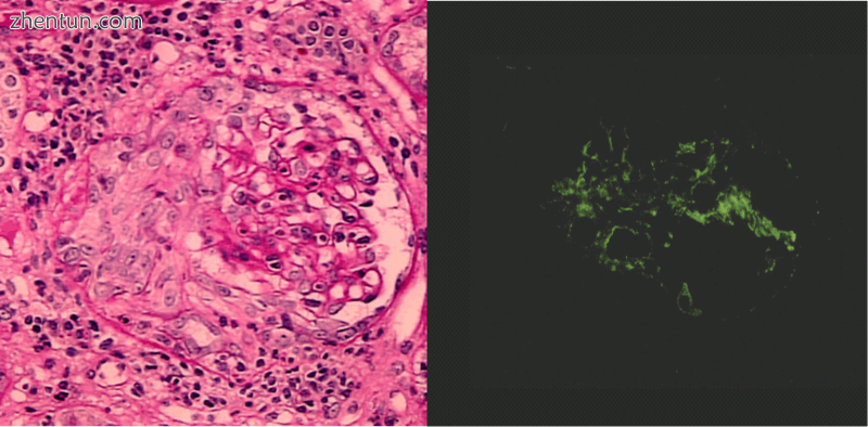 Crescentic glomerulonephritis induced by infective endocarditis on PAS staining.png