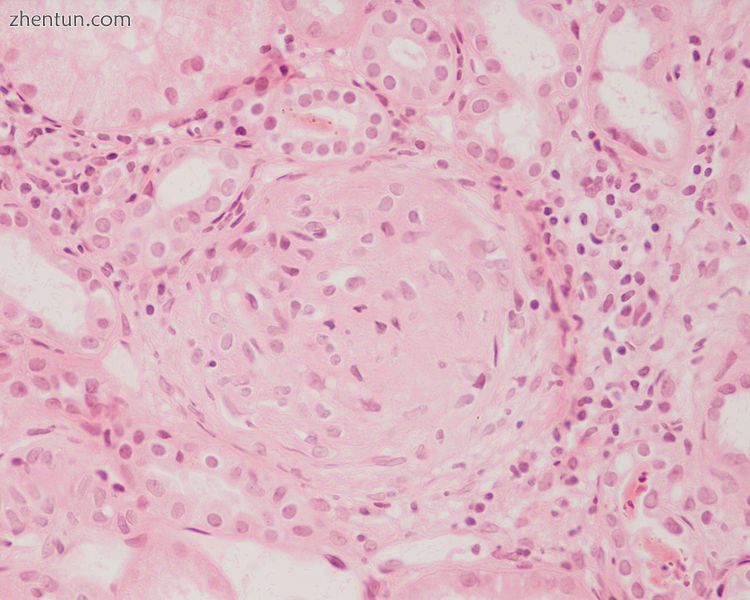 Photomicrograph of a kidney biopsy from a person with crescentic glomerulonephri.jpeg