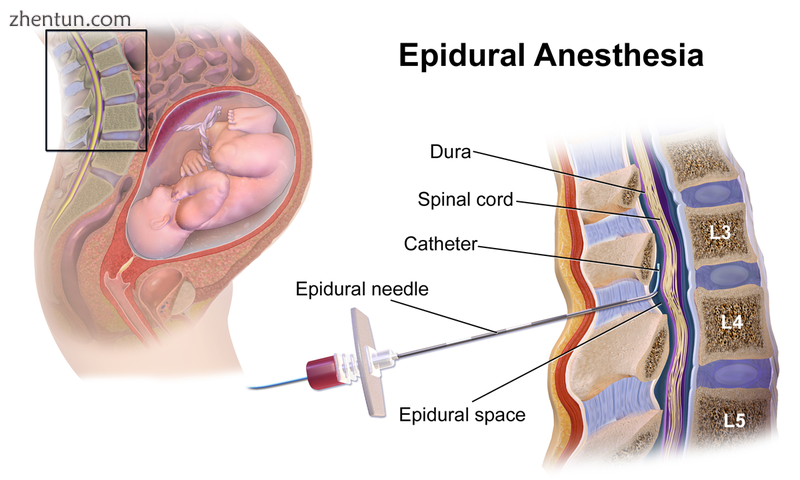 Epidural Anesthesia..png