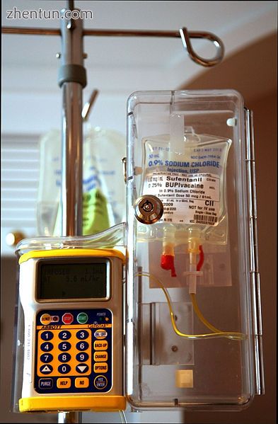 Epidural infusion pump with opioid (sufentanil) and anesthetic (bupivacaine) in .jpg