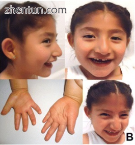 A five-year-old Mexican girl with Angelman syndrome. Fea.png