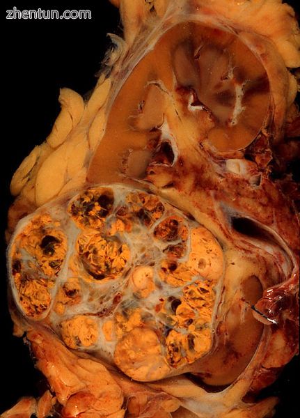 Renal cell carcinoma.jpg