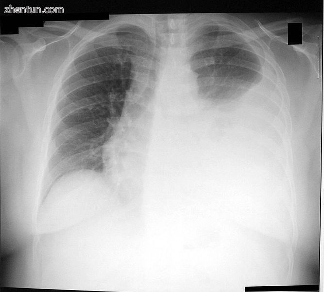 Chest X-ray showing a left-sided pleural effusion (right side of image). This ca.jpg