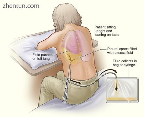 The illustration shows a person having thoracentesis. The person sits upright an.jpg