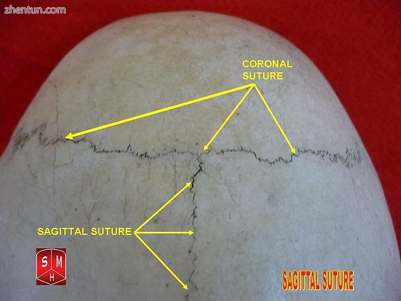 Sagittal suture.3.jpg