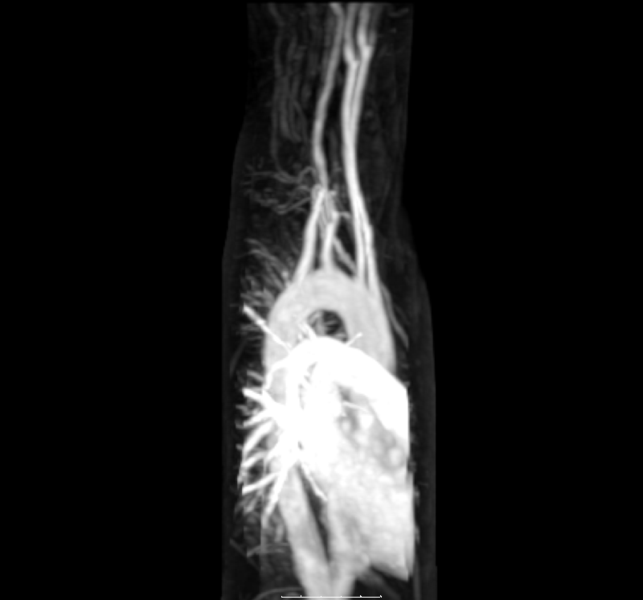 Magnetic resonance angiography of aberrant subclavian artery.gif