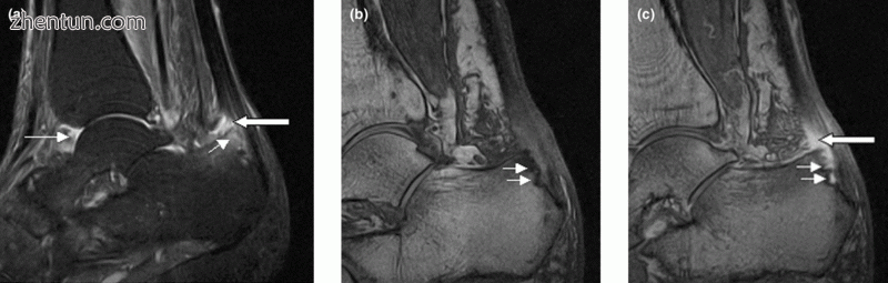 Sagittal magnetic resonance images of the ankle region in psoriatic arthritis. (.gif