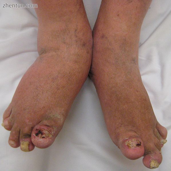Severe psoriatic arthritis of both feet and ankles. Note the changes to the nails..JPG