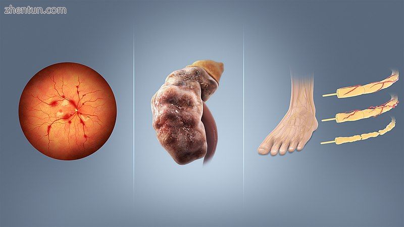 Retinopathy, nephropathy, and neuropathy are potential complications of diabetes.jpg
