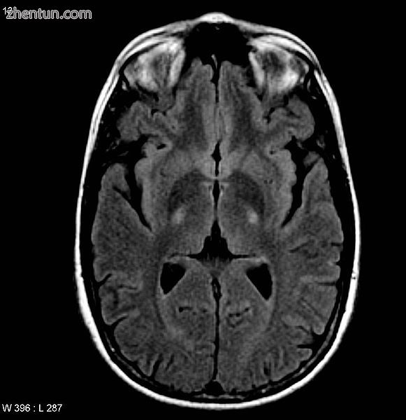 MRI (axial FLAIR) demonstrates increased T2 signal within the posterior part of .jpg