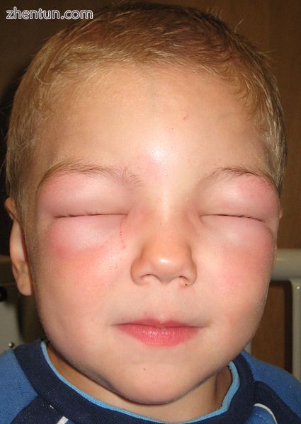 Angioedema of the face such that the boy cannot open his eyes. This reaction was.jpg