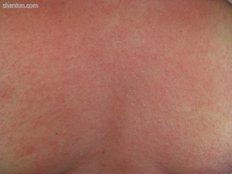 Urticaria and flushing on the back of a person with anaphylaxis.jpg