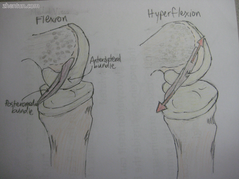 In this medial view of the flexed knee, the lateral femoral condyle has been rem.png
