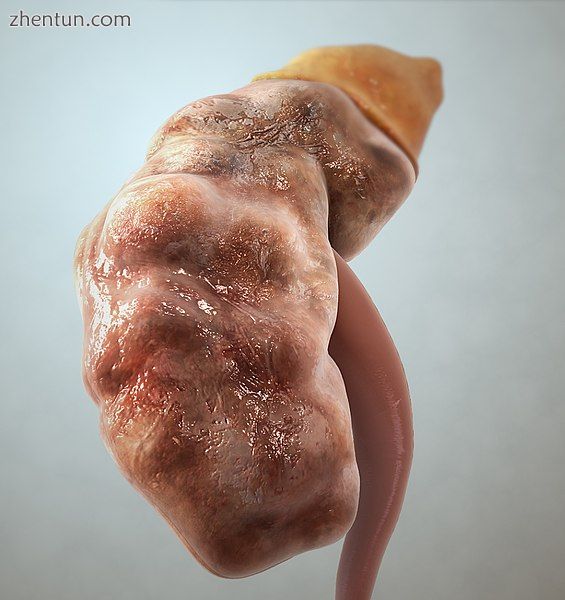 Graphic representation of a CKD affected kidney..jpg