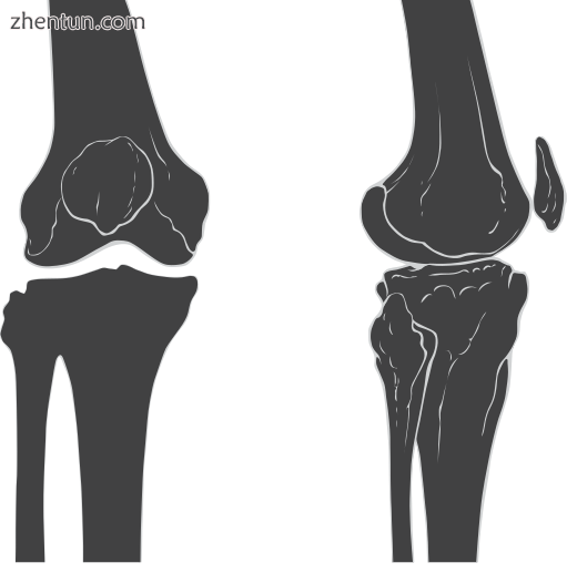 Anterior and lateral view of knee..png