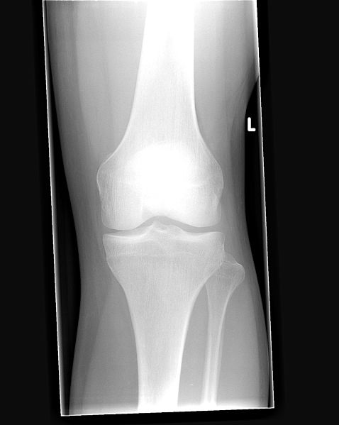 Knee X-ray (Front).jpg