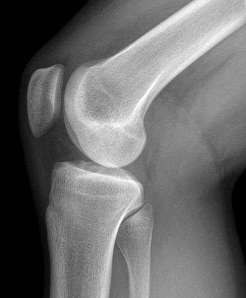 Knee X-ray.jpg