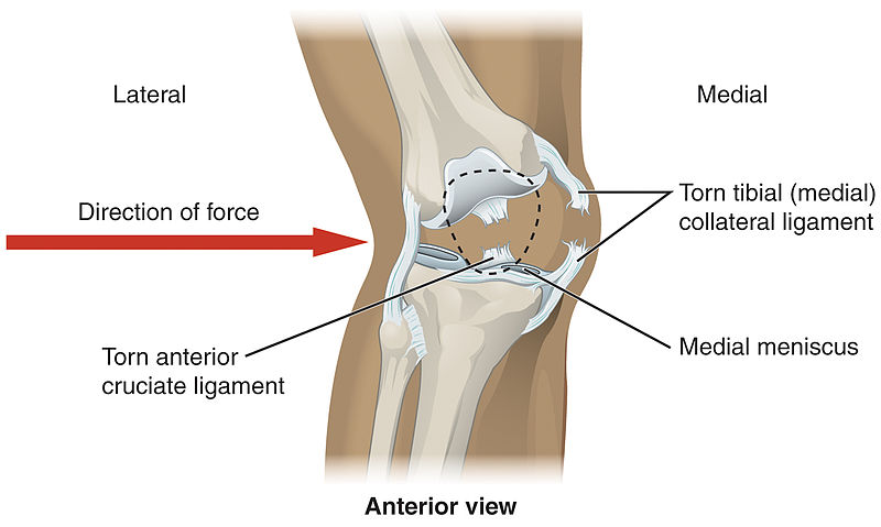 Lateral trauma to the knee can cause torn medial collateral ligaments, cruciate .jpg
