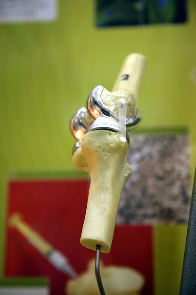 Model demonstrating parts of an artificial knee.jpg