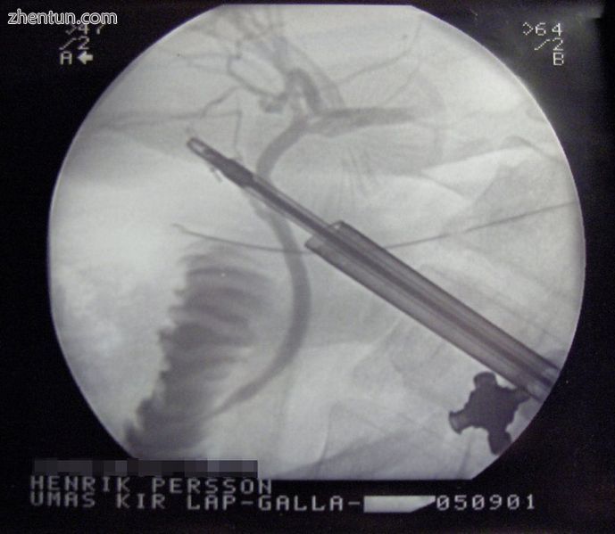An intraoperative cholangiogram, which is an X-Ray of the bile ducts during a la.jpg