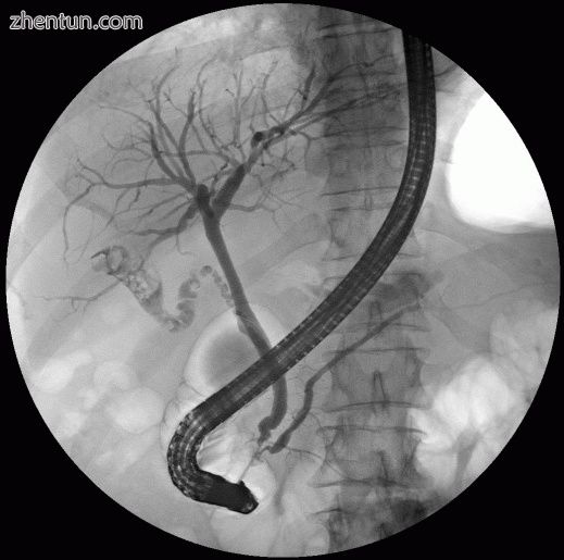 ERCP image showing the biliary tree and the main pancreatic duct..jpg
