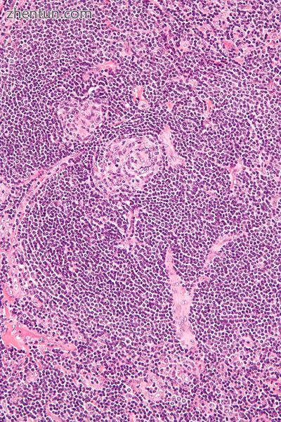 Micrograph of Castleman&#039;s disease, hyaline vasc.jpg