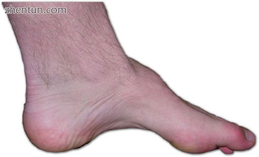 The foot of a person with Charcot–Marie–Tooth disease The lack of muscle, a hi.jpg