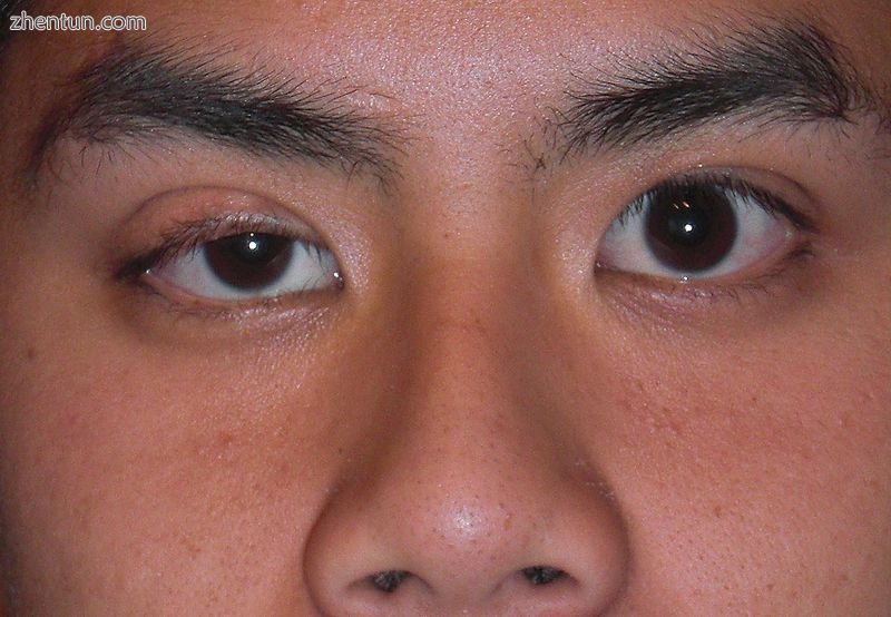 Mild right eyelid ptosis.JPG