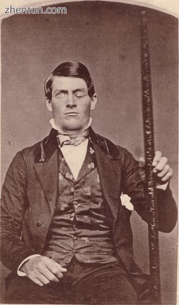 Phineas Gage displayed ptosis after a large iron rod entered his left cheek, pas.jpg