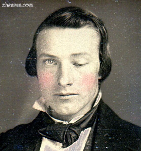 Ptosis of the left eyelid (unilateral ptosis). A headshot daguerreotype of an un.jpg