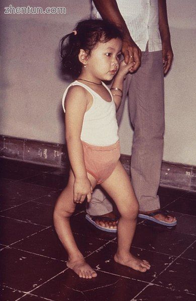 A girl with a deformity of her right leg due to polio.jpg