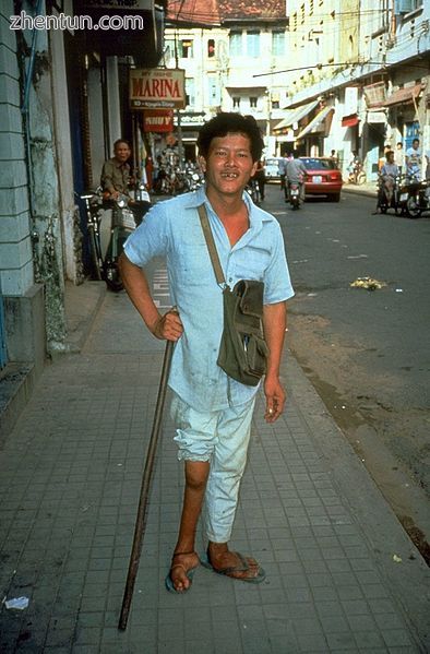 A man with a smaller right leg due to poliomyelitis.jpg