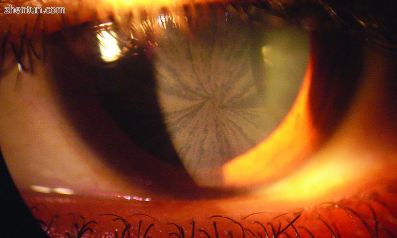 A bilateral, whorl-like corneal pattern of cream -colored lines in a person with.jpg