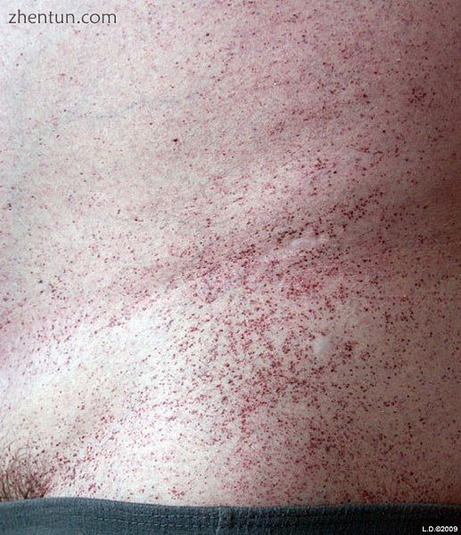 Angiokeratoma, a common skin manifestation in Fabry&#039;s.jpg