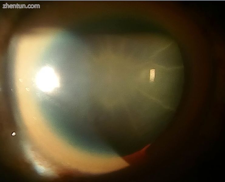Sunflower cataract and thick KF ring of a 40 years old male with Wilson&#039;s d.jpg