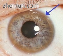A brown ring on the edge of the cornea (Kayser–Fleischer ring) is common in Wil.jpg