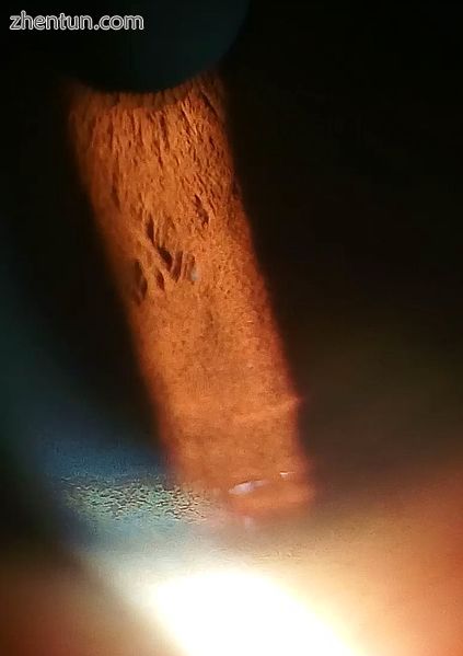 Copper disposition on corneal Descemet&#039;s membrane.jpg
