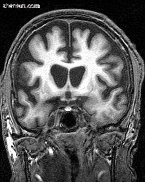 Coronal section from an MR brain scan of a patient with HD, showing atrophy of t.jpg
