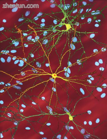 An edited microscopic image of medium spiny neurons (yellow) with nuclear inclus.jpg